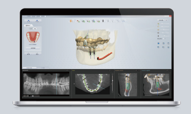 Prosthetically-Driven Implant Design