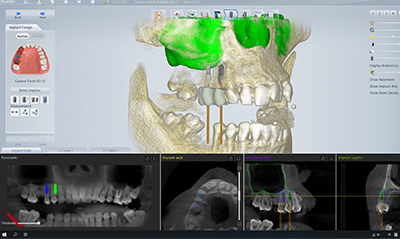 Pre-surgical Plan Validation