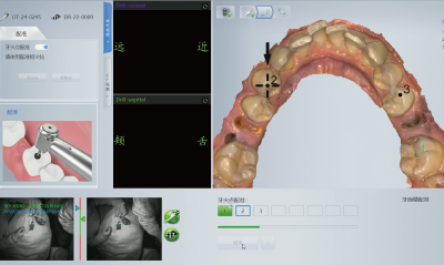 Preoperative Setup (Registration)