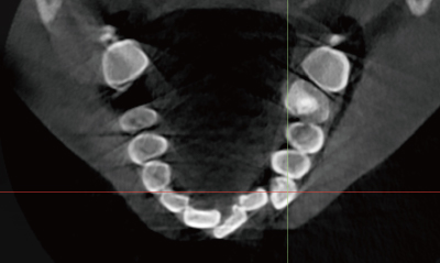 Pre-op CBCT / IOS